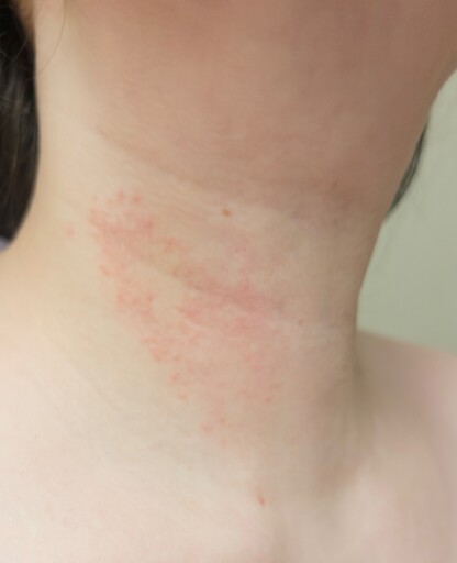 A close up of a white person's neck with a large pink rash in the shape similar to a thyroid lobe.